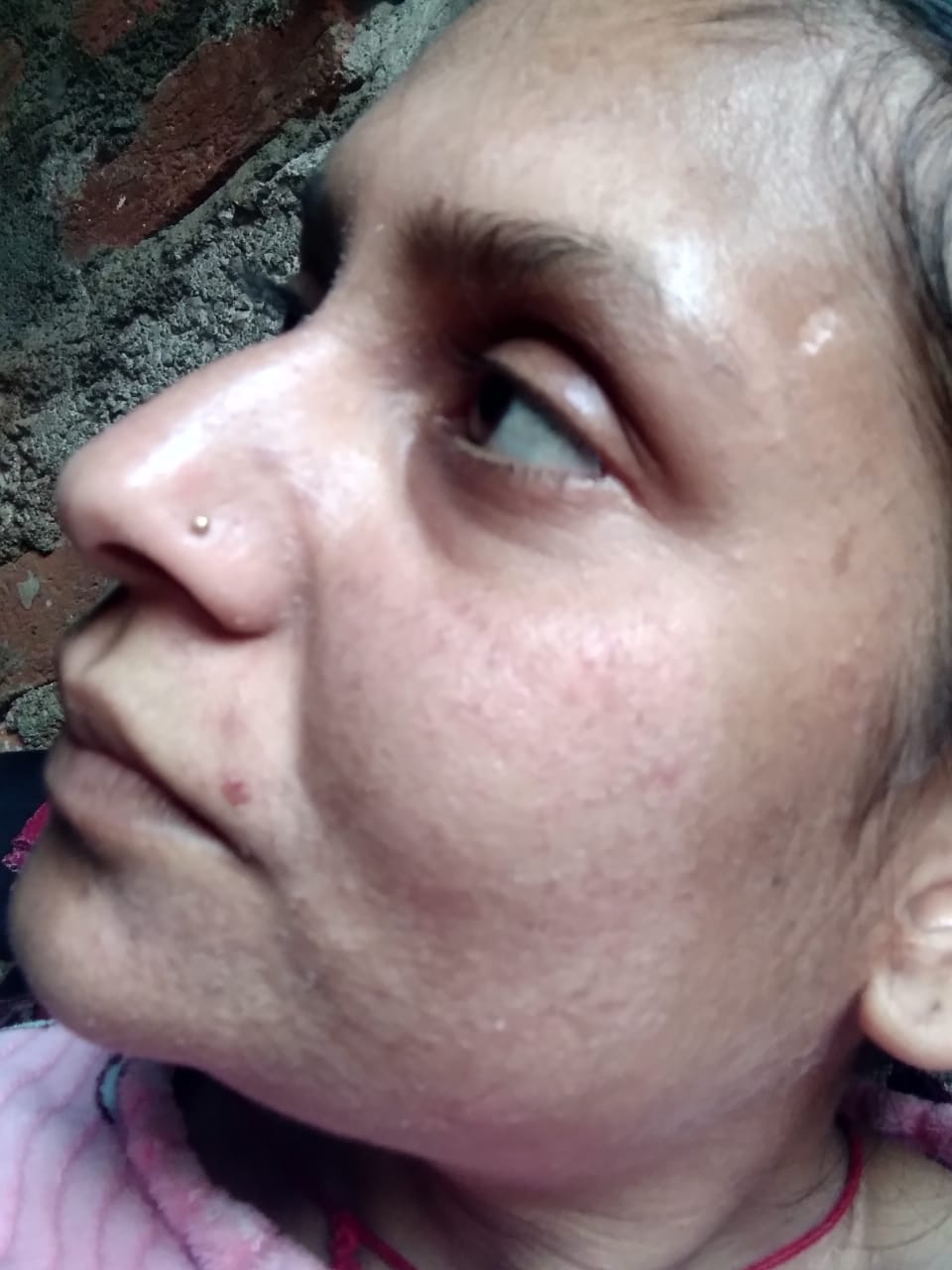 Acne cleared significantly after 6 weeks of medical treatment