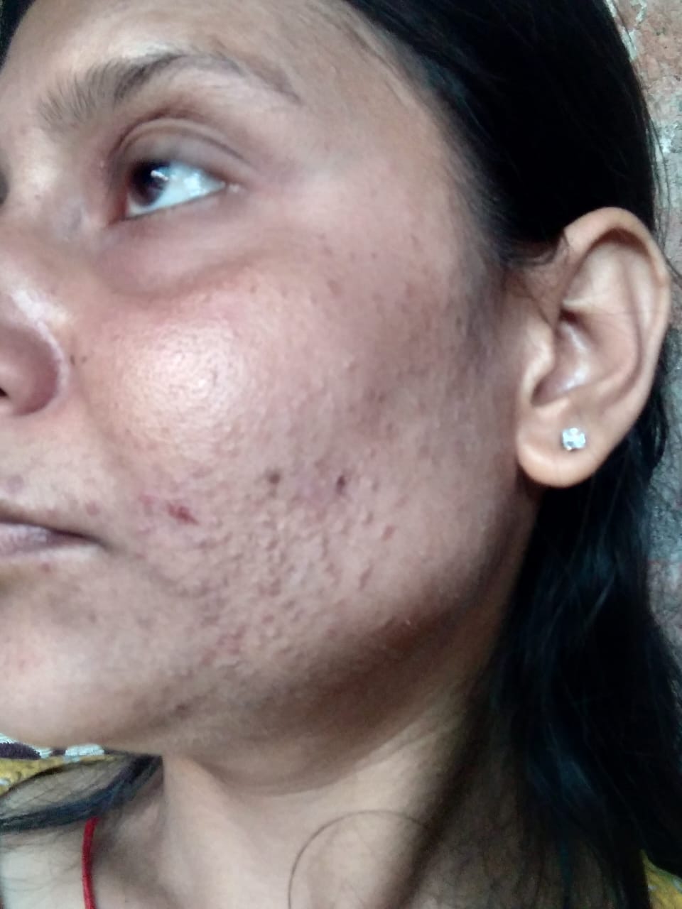 Severe nodulocystic acne before treatment