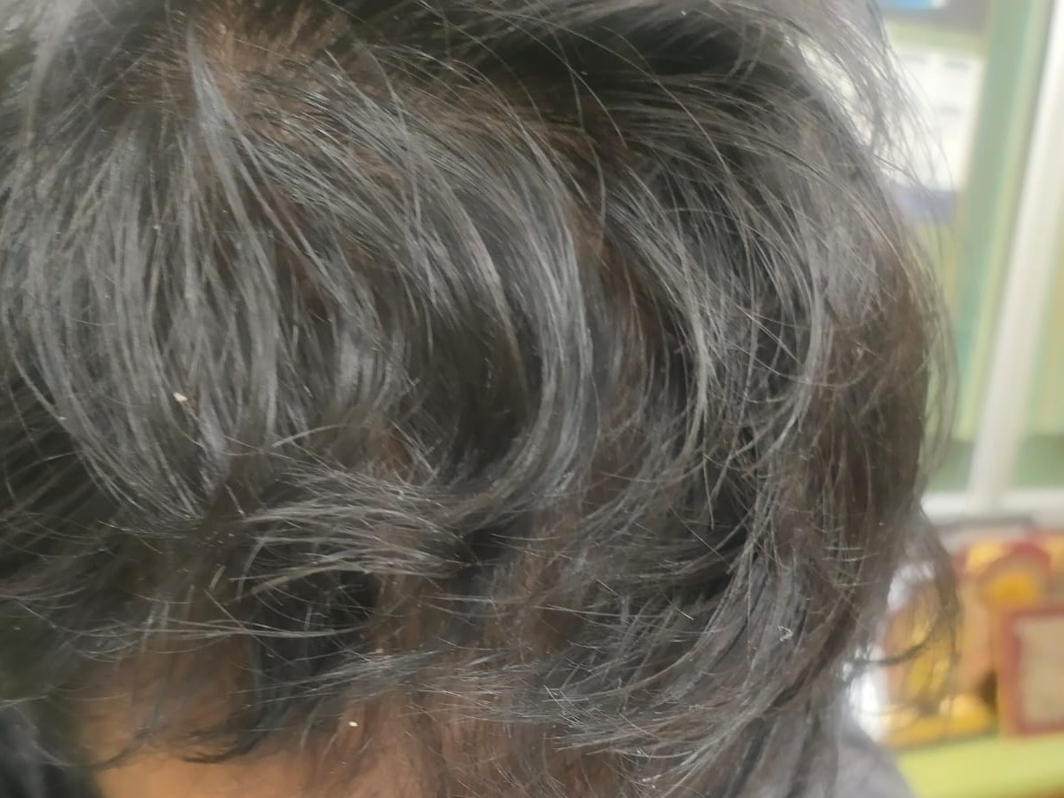 Improved hair density and reduced thinning after 4 months