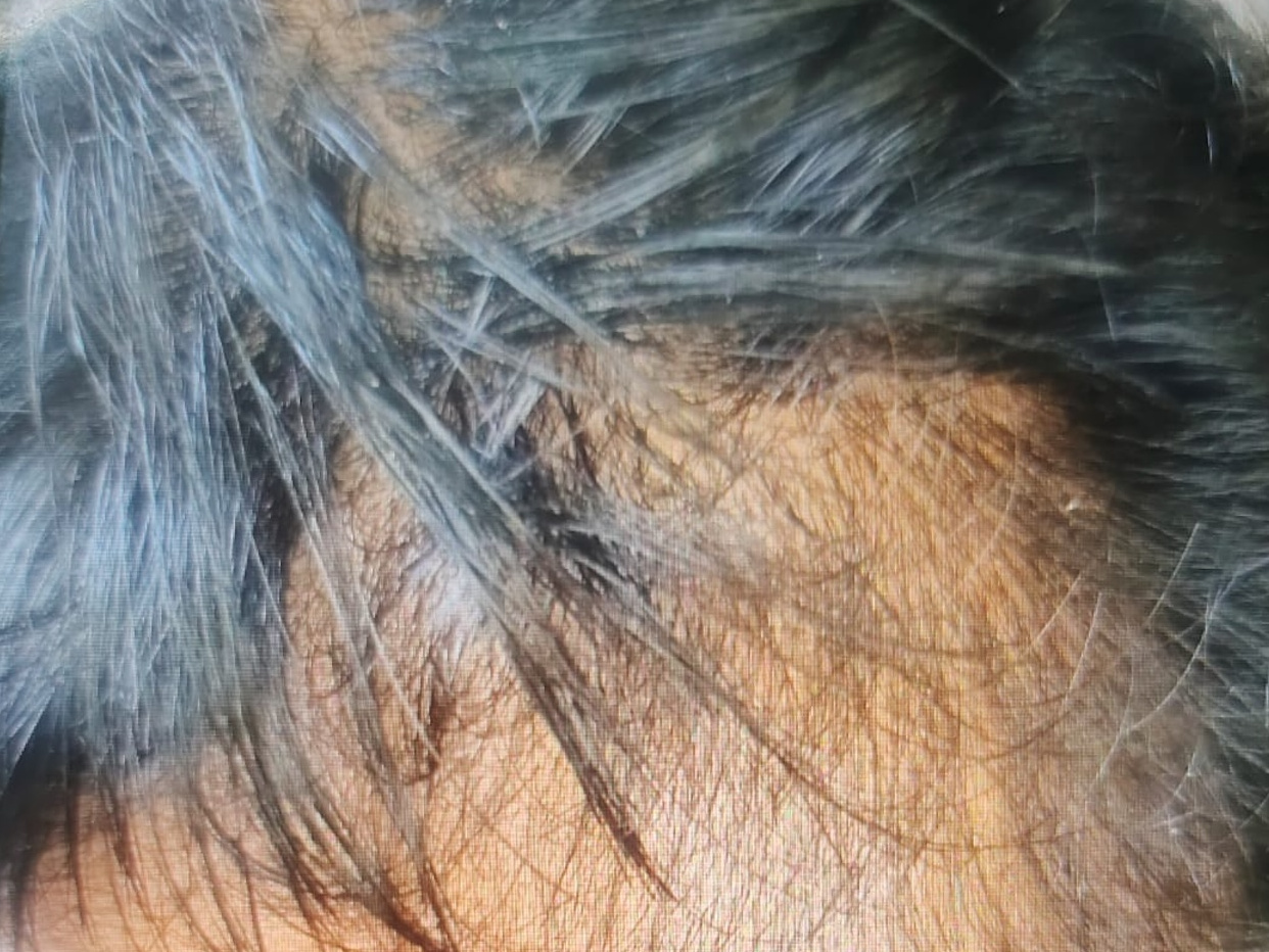 Visible hair thinning and reduced density before treatment