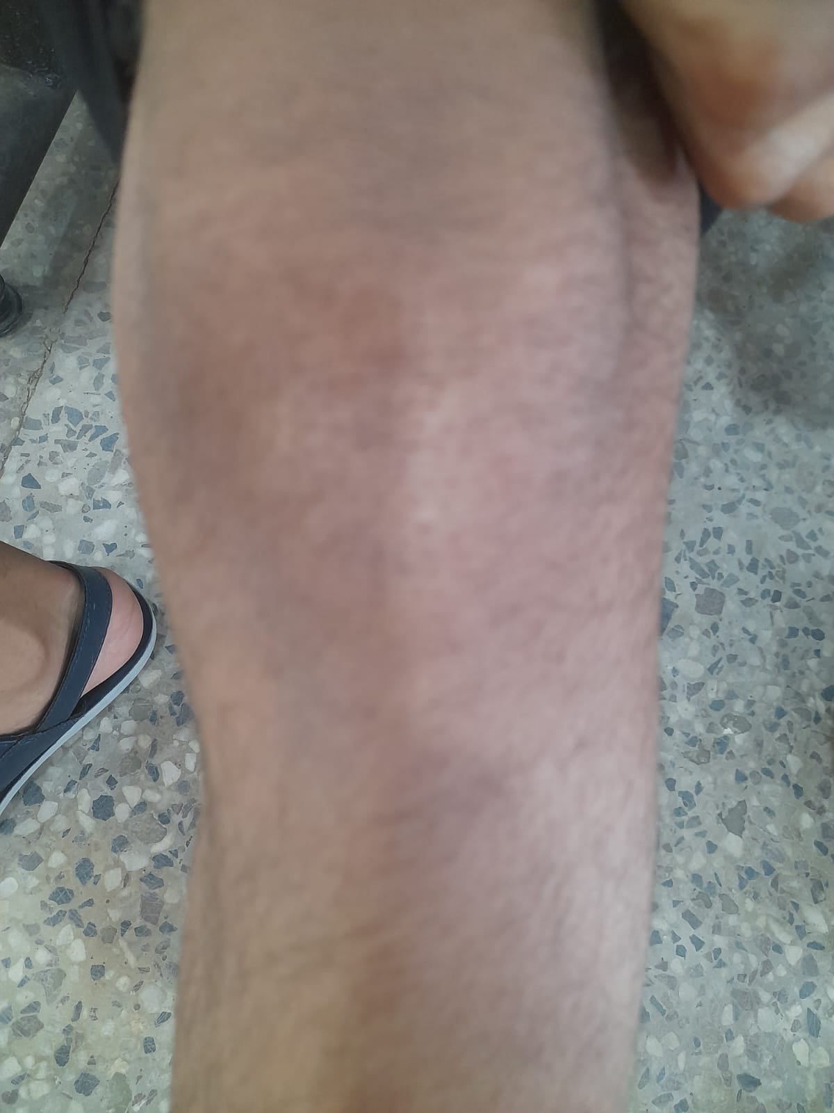 Visible improvement in acne scarring after 3 months of topical treatment