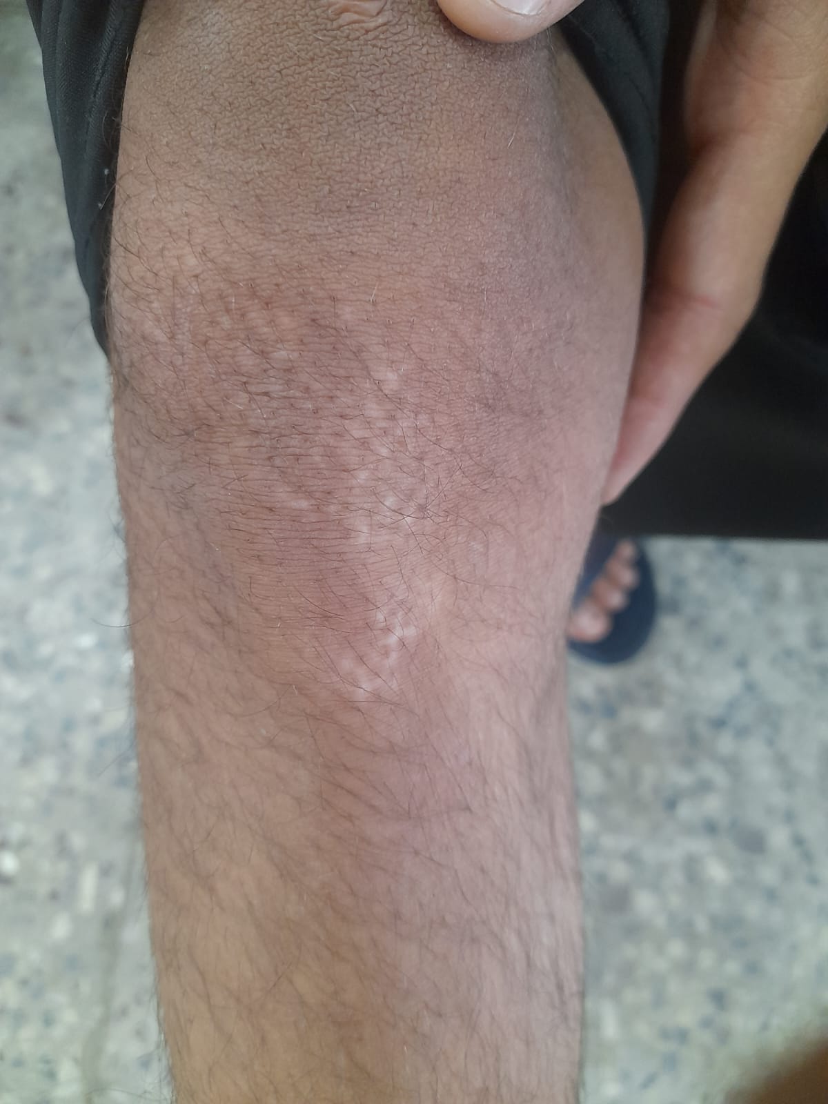 Atrophic acne scars before treatment