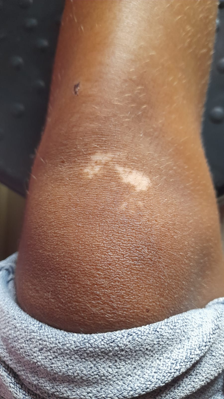 Significant repigmentation achieved after 5 months of treatment