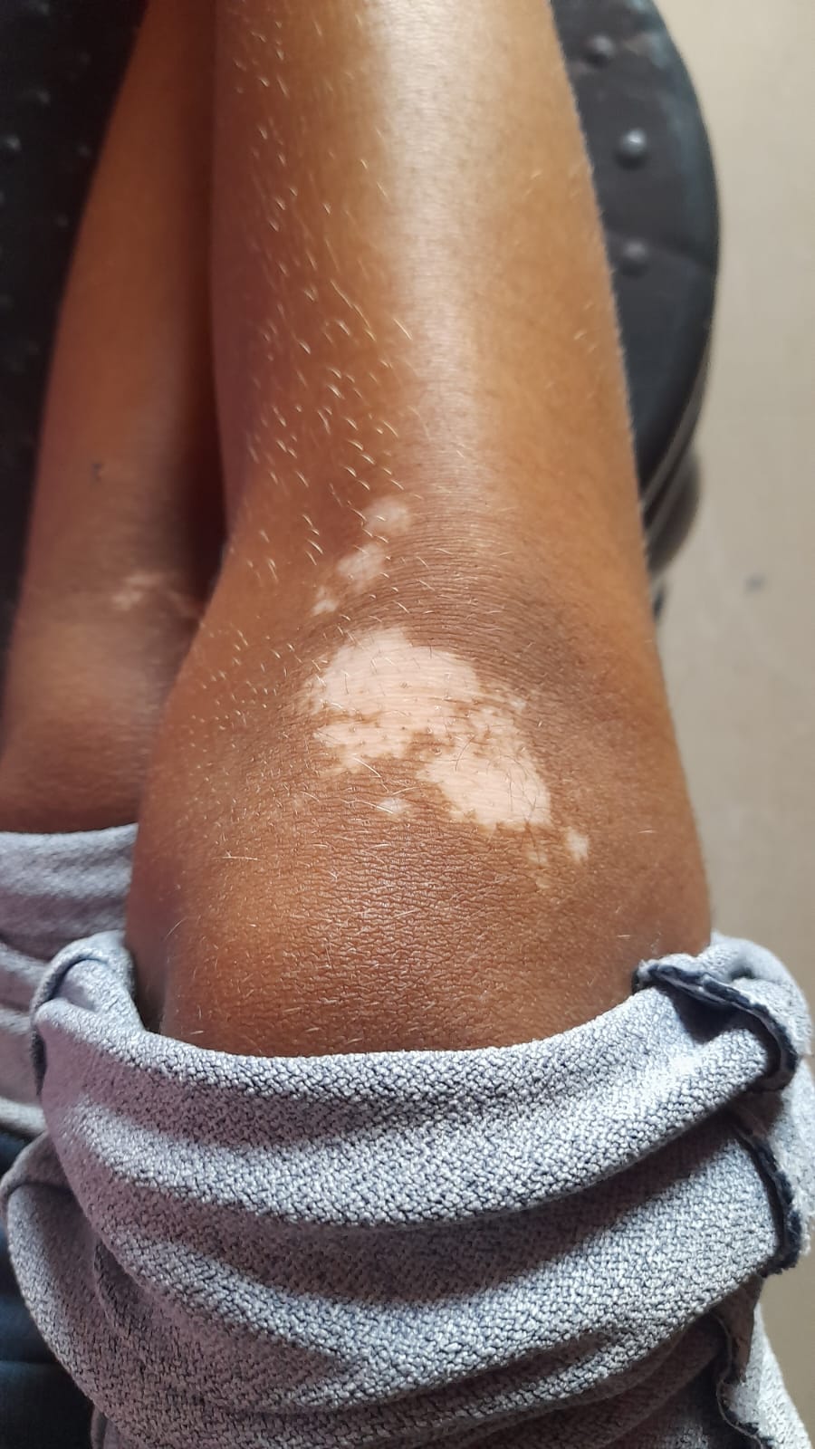 Vitiligo patches on face before treatment